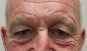 Before upper blepharoplasty