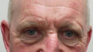 After upper blepharoplasty