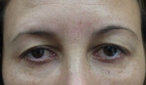 Before upper blepharoplasty