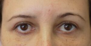 3 months after upper blepharoplasty