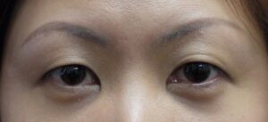 Before Asian blepharoplasty and medial epicanthopexy