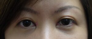 3 months post operative after an asian (double eyelid) blepharoplasty and a medial epicanthoplasty