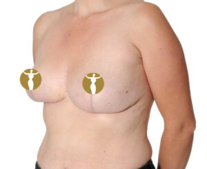 3 months after breast reduction