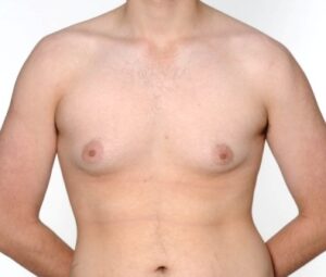 Before gynaecomastia surgery