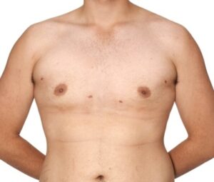 after gynaecomastia surgery