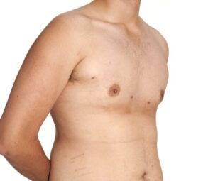 after gynaecomastia surgery