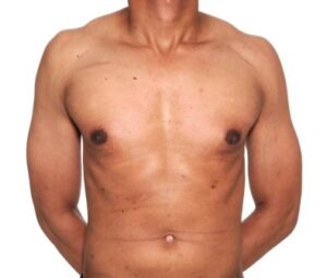 after gynaecomastia surgery