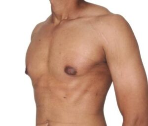 after gynaecomastia surgery