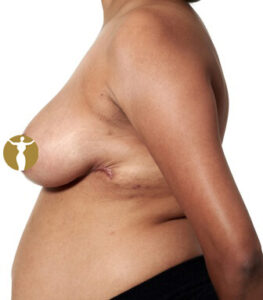 3 months after breast reduction