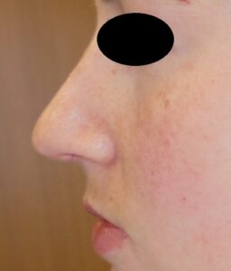 Post operative rhinoplasty at 3 months