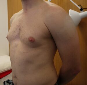 Before gynaecomastia and abdominal surgery